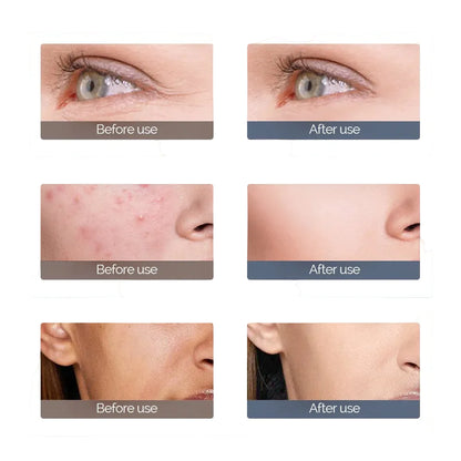 Leviro™ 7 LED Light Therapy Spectral Mask