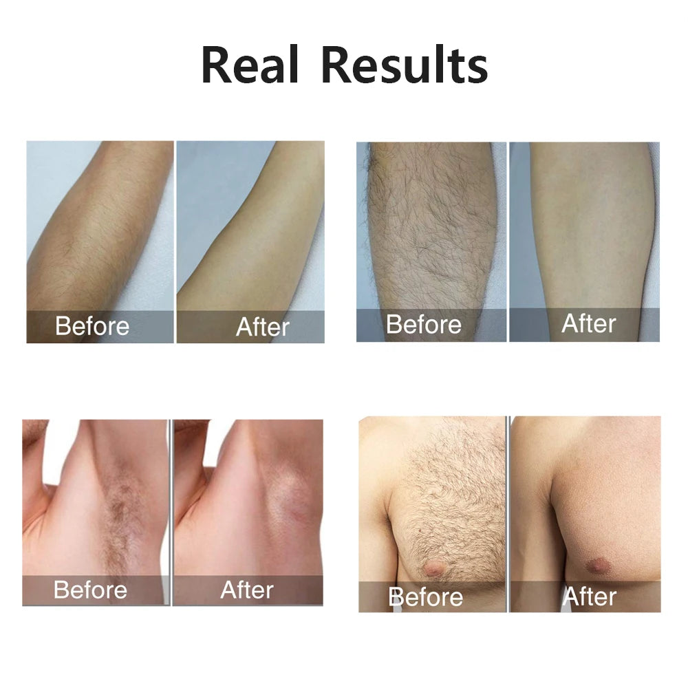 Leviro™ Emerald Pro IPL Hair Removal Device