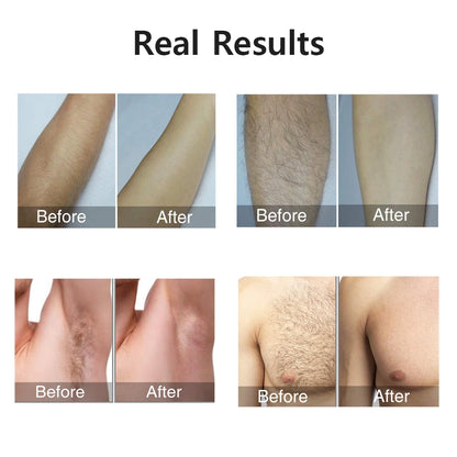 Leviro™ Emerald Pro IPL Hair Removal Device
