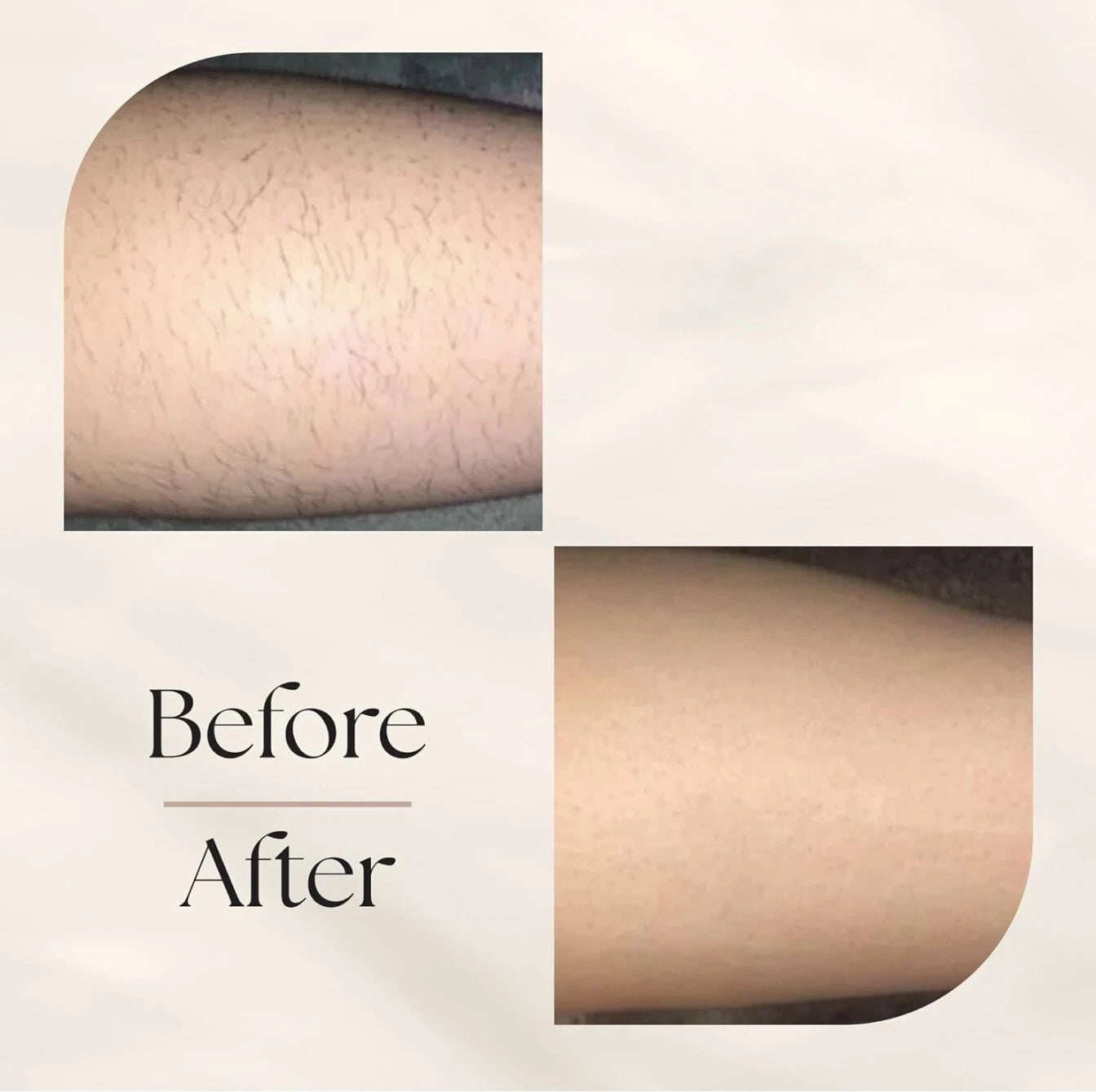Leviro™ LumiPulse IPL Hair Removal Device